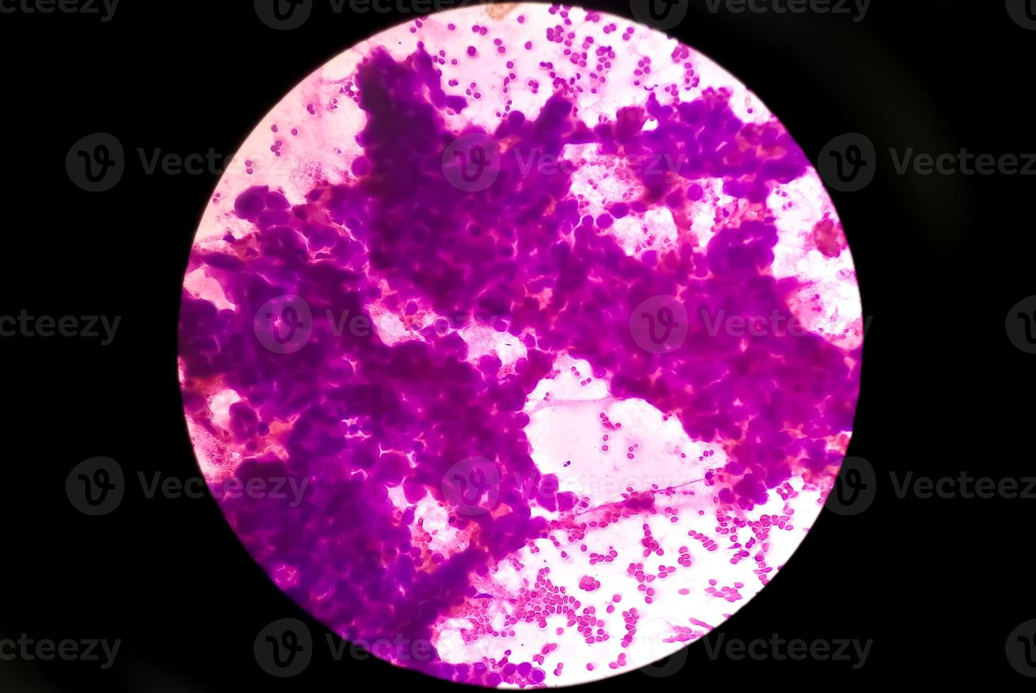 Photomicrograph of Mucoepidermoid carcinoma of parotid gland photo