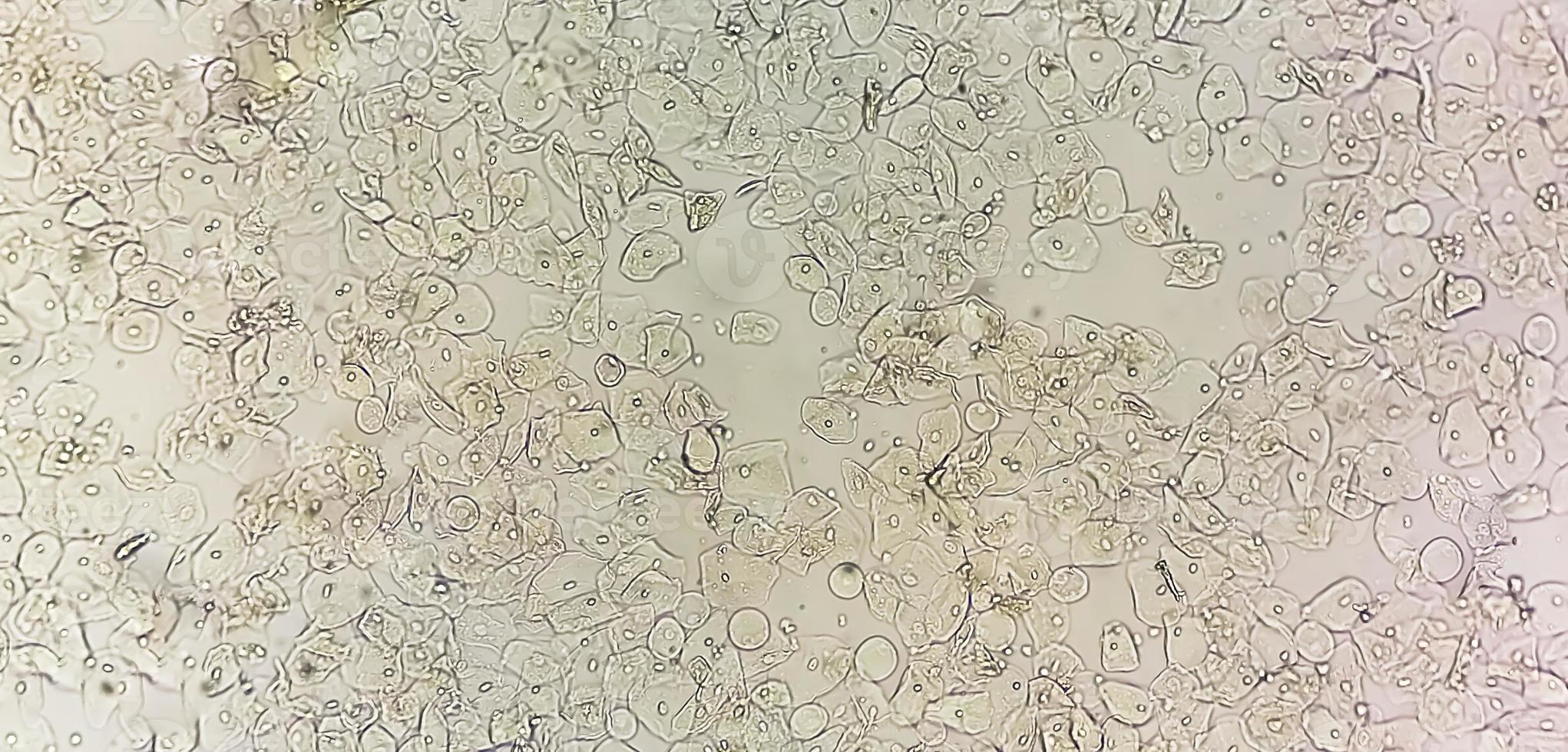 Photomicrographic close view of Abnormal urine analysis. Epithelial cell, Pus cell. photo