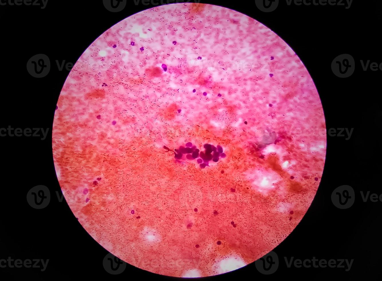 Metastatic adenocarcinoma of lung. Pleural fluid cytology of lung papillary adenocarcinoma, a type of non small cell carcinoma photo