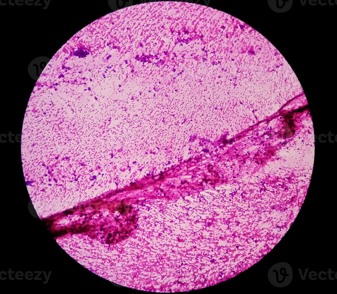 microfotografía de adenocarcinoma metastásico de pulmón foto