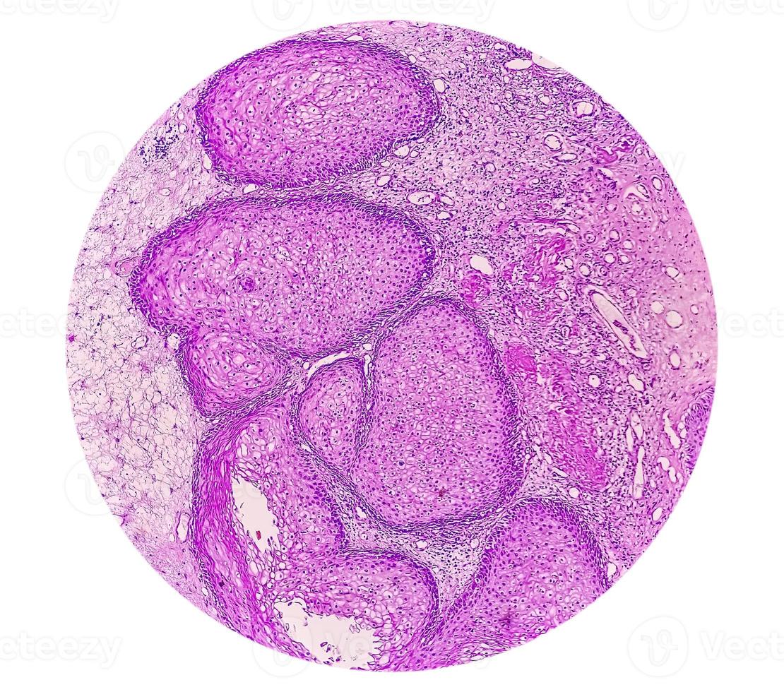 Photomicrograph of an sinonasal inverted papilloma a benign tumor that may occur in the nasal cavity or paranasal sinuses, 40X photo