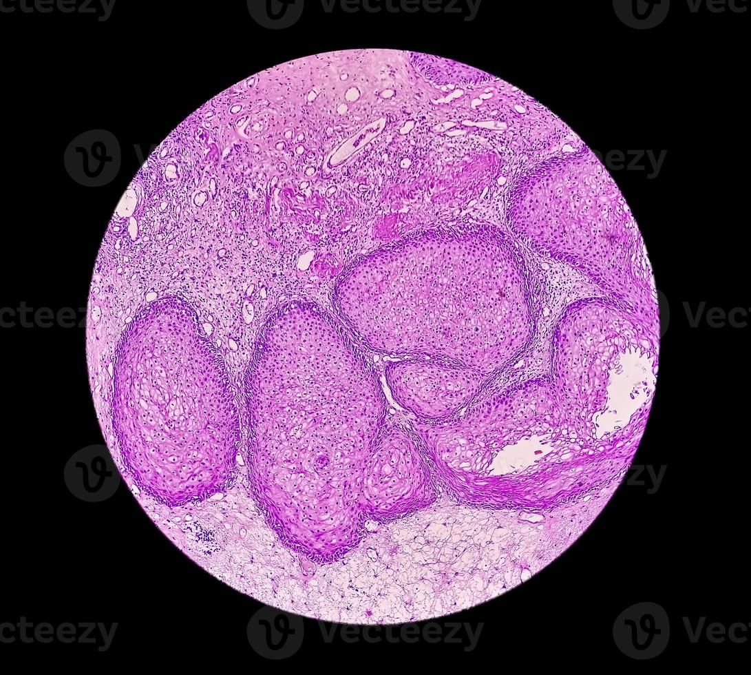 Photomicrograph of an sinonasal inverted papilloma a benign tumor that may occur in the nasal cavity or paranasal sinuses, 40X photo