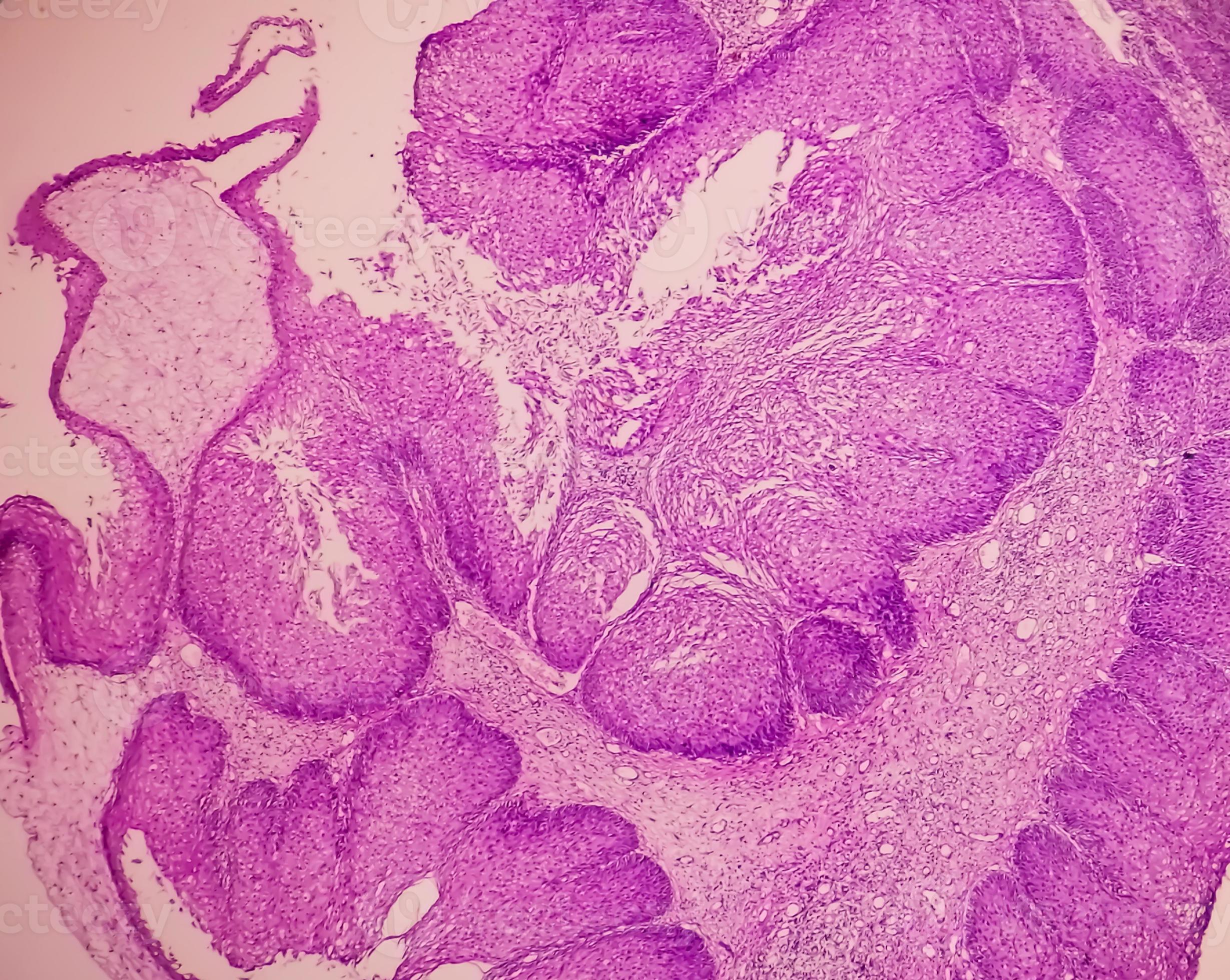 Arcüreggyulladás (orrmelléküreg-gyulladás) tünetei és kezelése - Papilloma sinus üreg