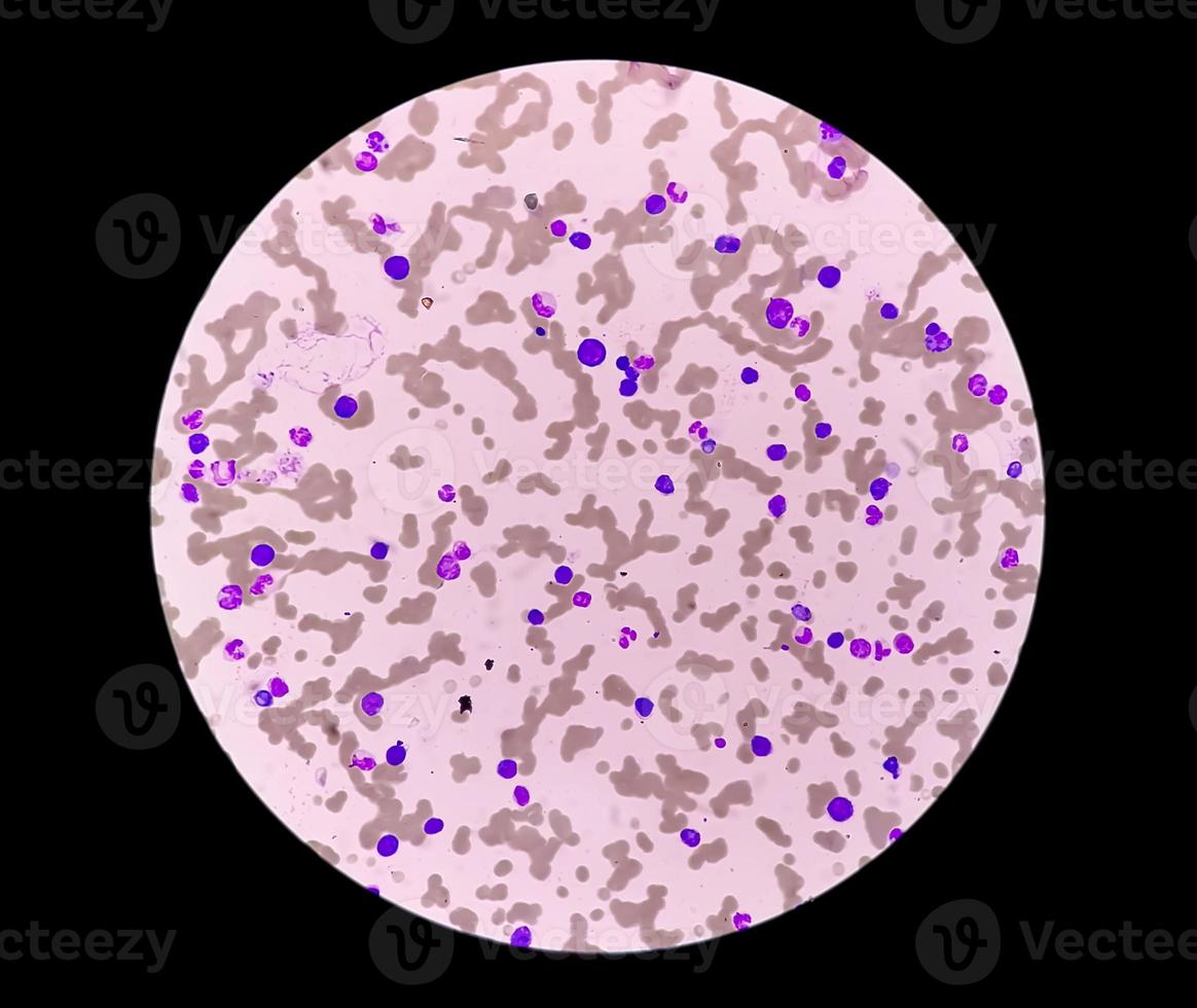 Photomicrograph of Plasma cell leukemia or Waldenstrom macroglobulinemia, a rare type of white blood cell Cancer photo