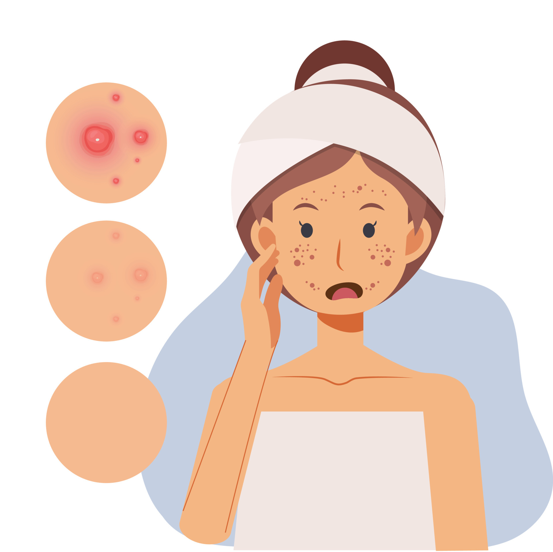 problem skin concept. Woman with pimples on her face,facial skin troubled.  flat vector cartoon character illustration. 5416276 Vector Art at Vecteezy