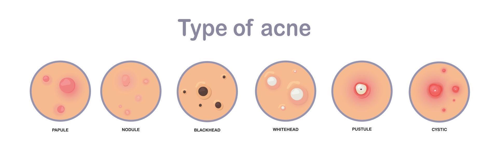 concepto de acné. tipo de acne.papule,nodule,blackhead'whitehead,pústula,cystic.flat ilustración vectorial. vector