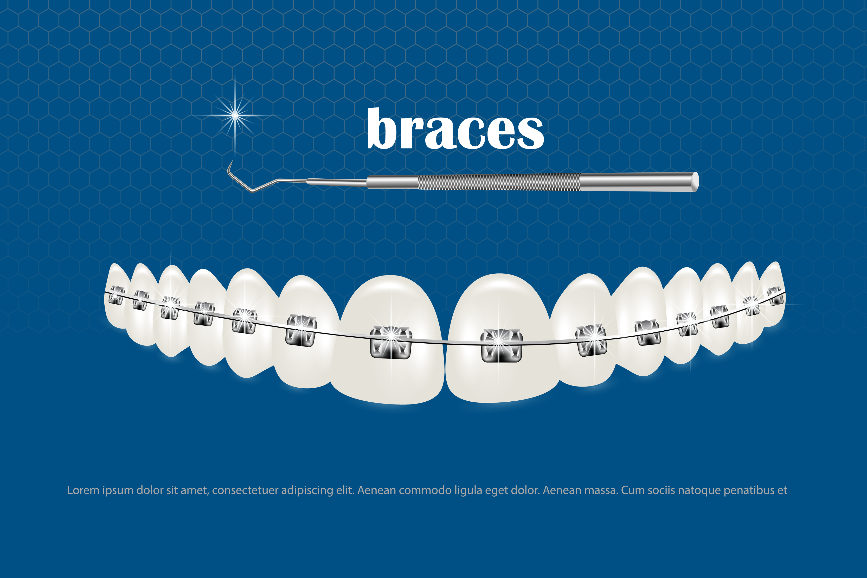 3d vector illustration, realistic teeth with braces. Alignment of the