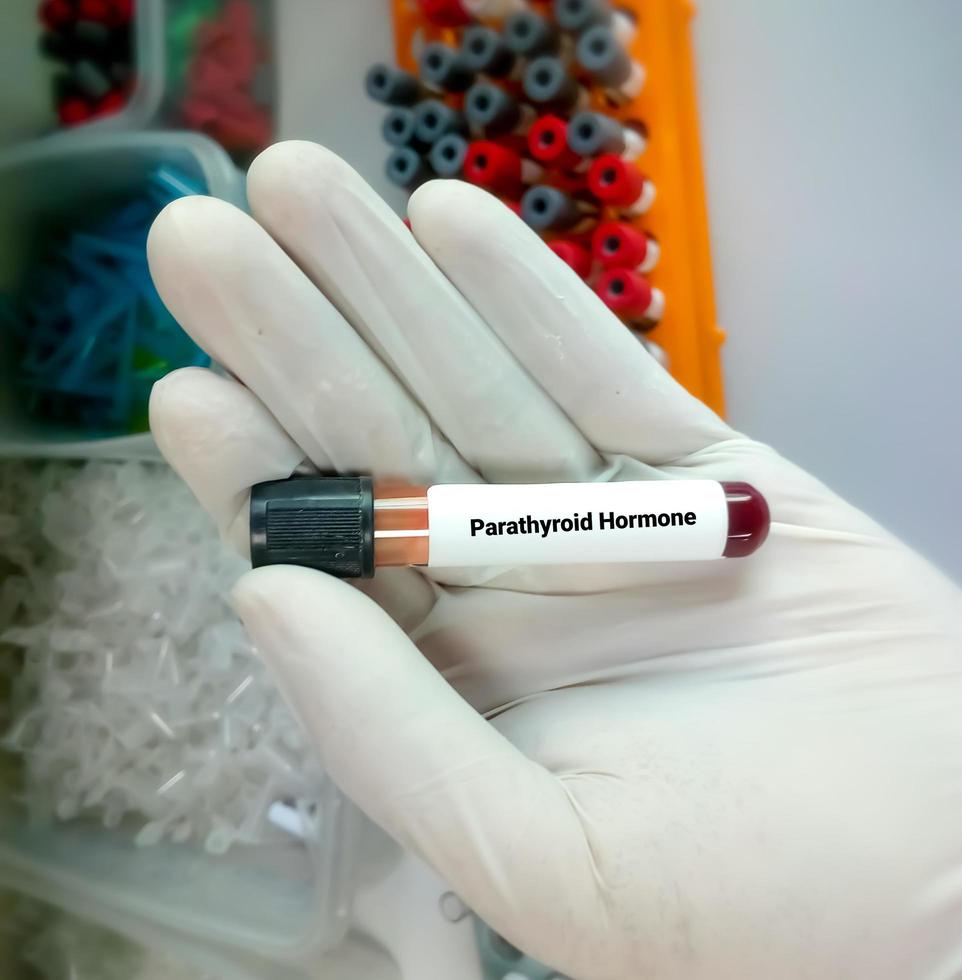 científico o bioquímico tiene una muestra para la hormona paratiroidea o la prueba de pth foto