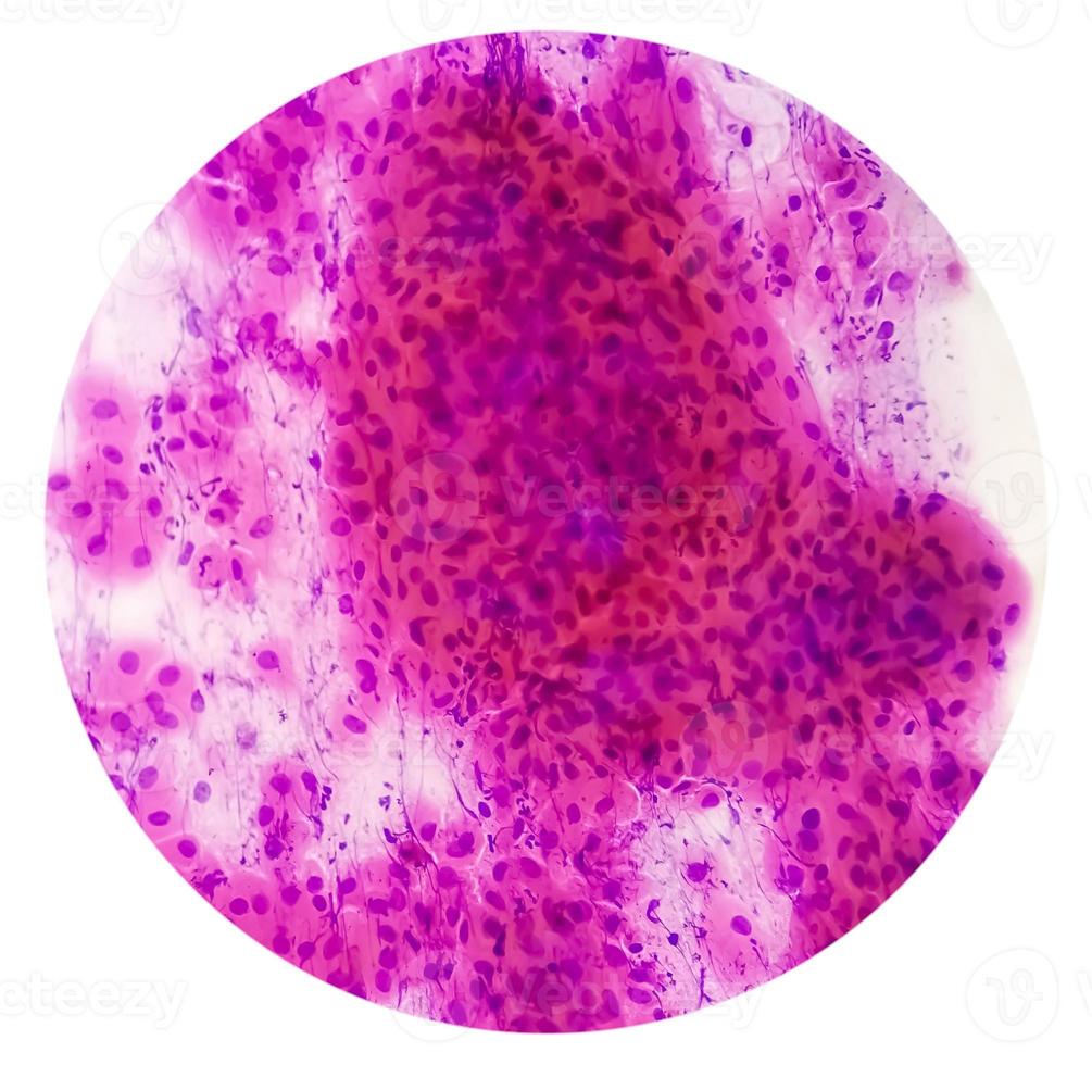 Pap's smear pap stain Microscopic 40x Zoom show High-grade squamous intraepithelial lesion is a pre-cancerous, sexually transmitted disease photo