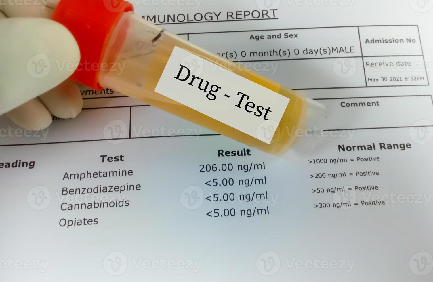 Technician hold urine sample for drug test. Drug test is technical analysis of specimen to determine illegal drug abuse as Benzodiazepine, Cannabis, amphetamine, opiates. photo