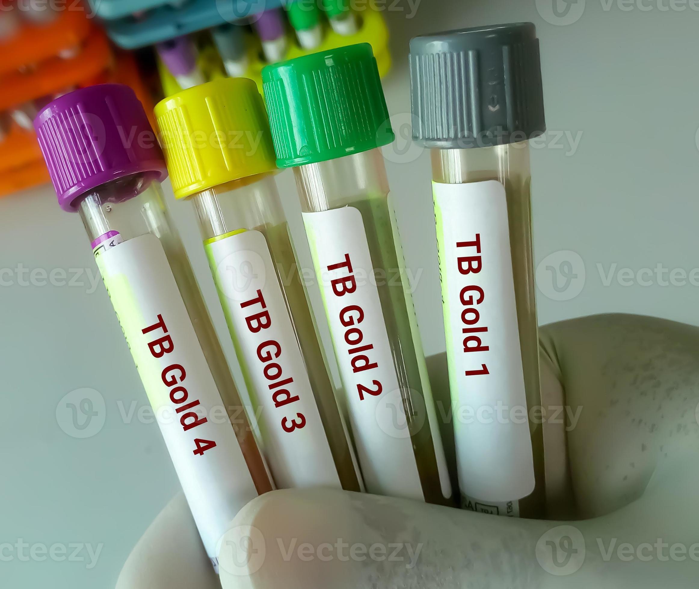 Close view of scientist hand hold blood samples for TB Gold or
