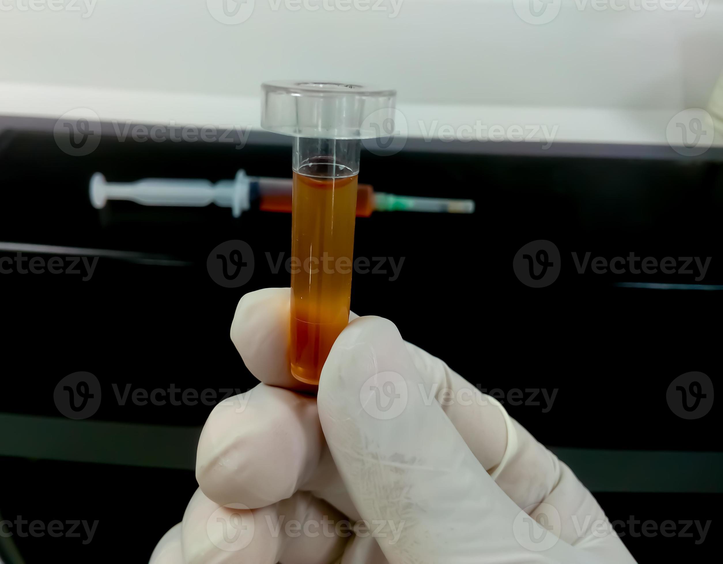Biochemist hold Cerebrospinal fluid or CSF sample, which is ready for