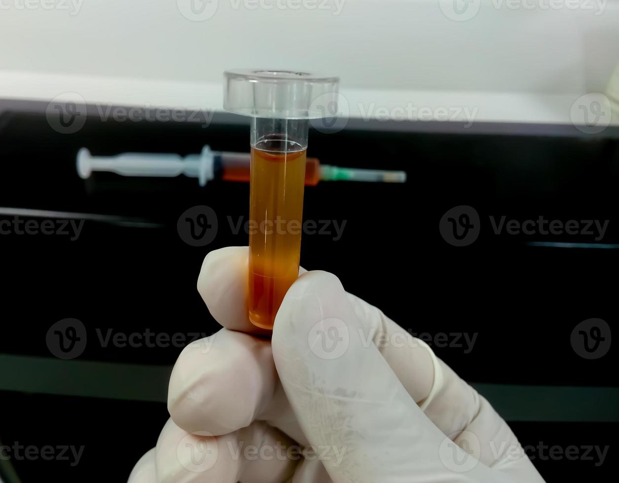 Biochemist hold Cerebrospinal fluid or CSF sample, which is ready for biochemical test including Glucose, Protein, ADA. Closeup photo