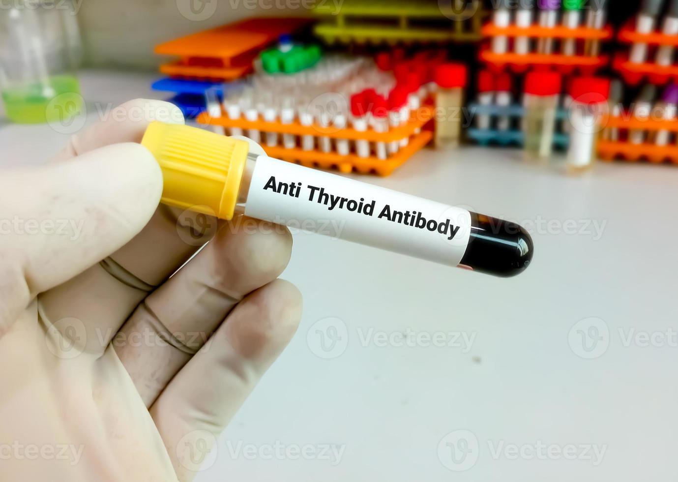 Blood sample for Anti Thyroid Antibody or Anti microsomal and anti thyroglobulin test. photo