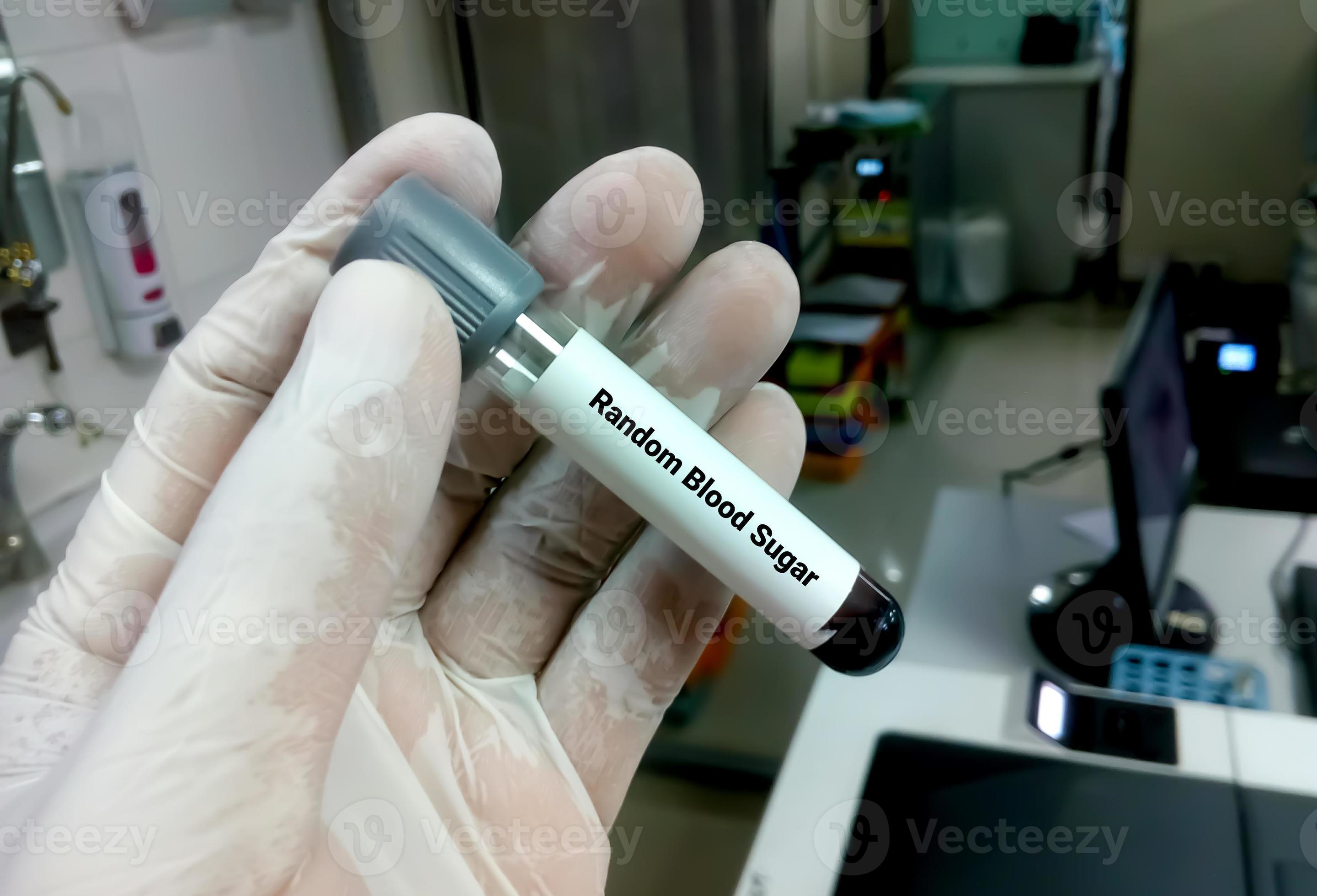 Technician or scientist hold a sample tube of Random Blood Sugar or RBS