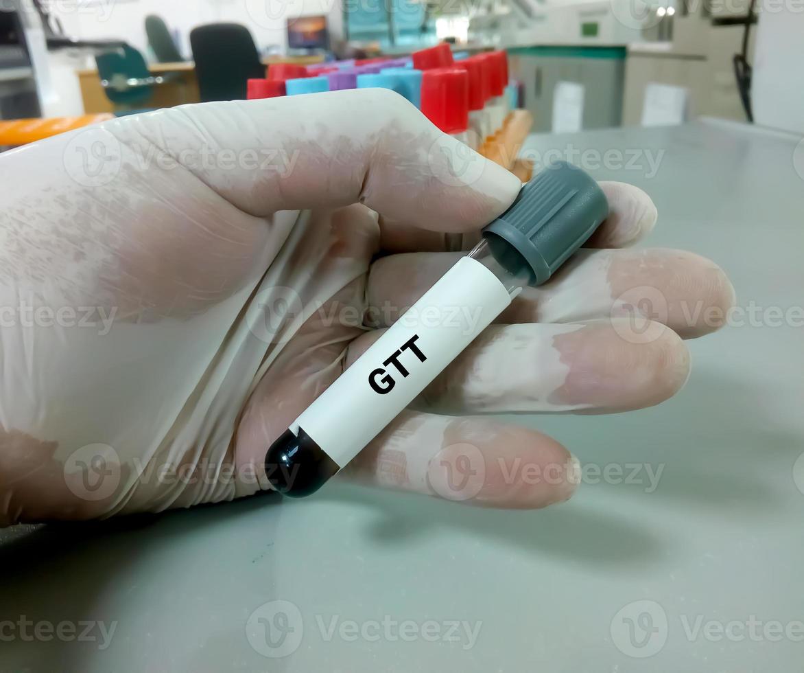 Technician or scientist hold a sample tube of Glucose Tolerance Test or GTT photo