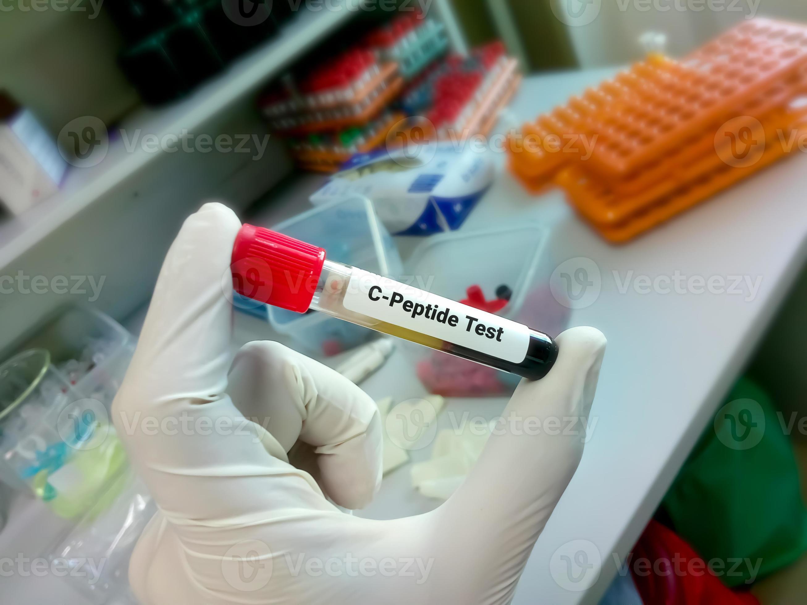 Blood sample tube for C peptide test, diagnosis of diabetes disease