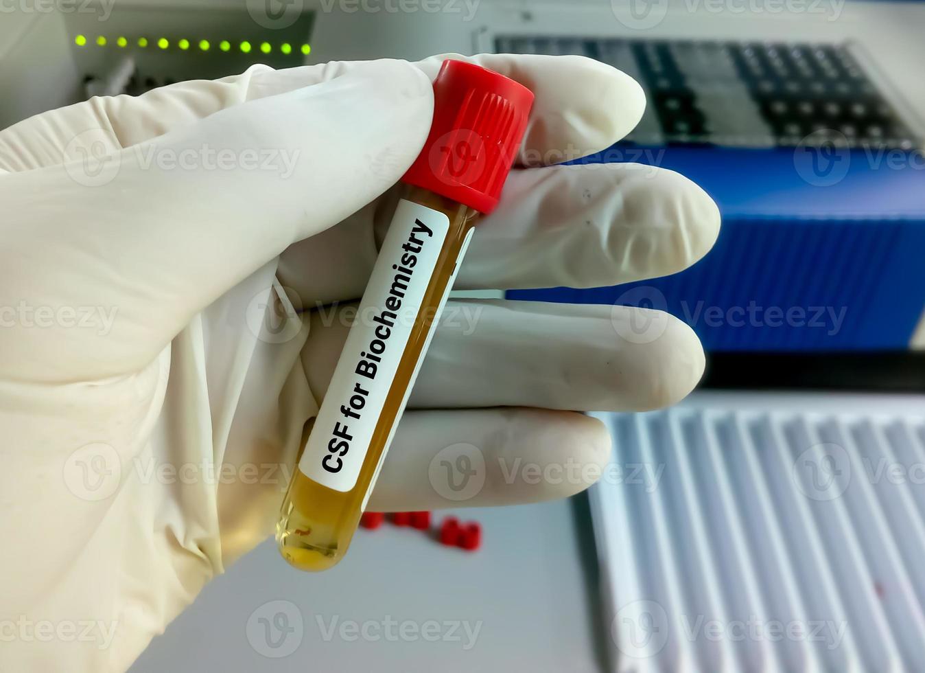 Biochemist hold Cerebrospinal fluid or CSf ample for biochemistry test including glucose, protein, ADA photo