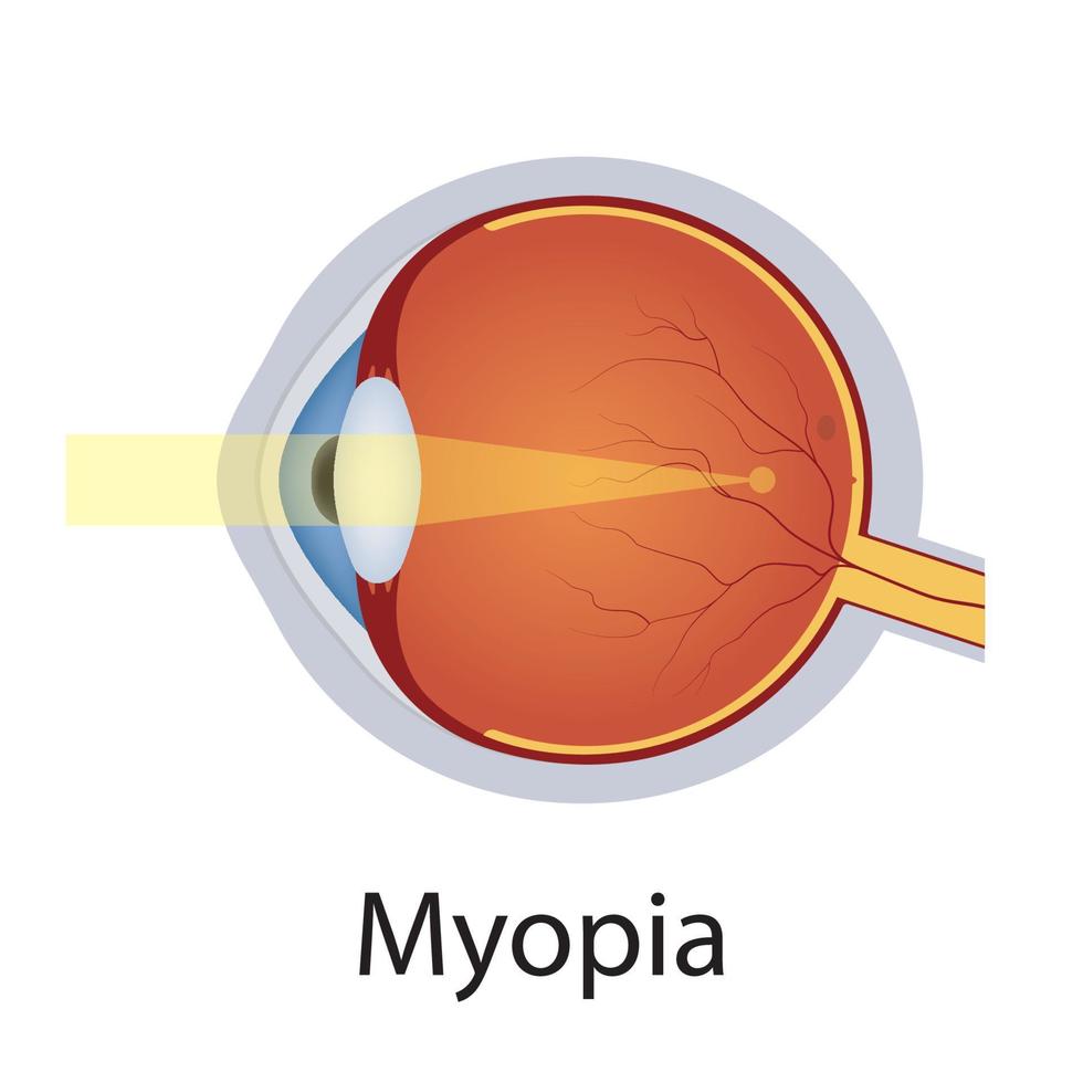 ilustración de miopía y trastornos de la visión. concepto de defecto ocular. globo ocular de anatomía detallada con defecto de miopía. vector aislado