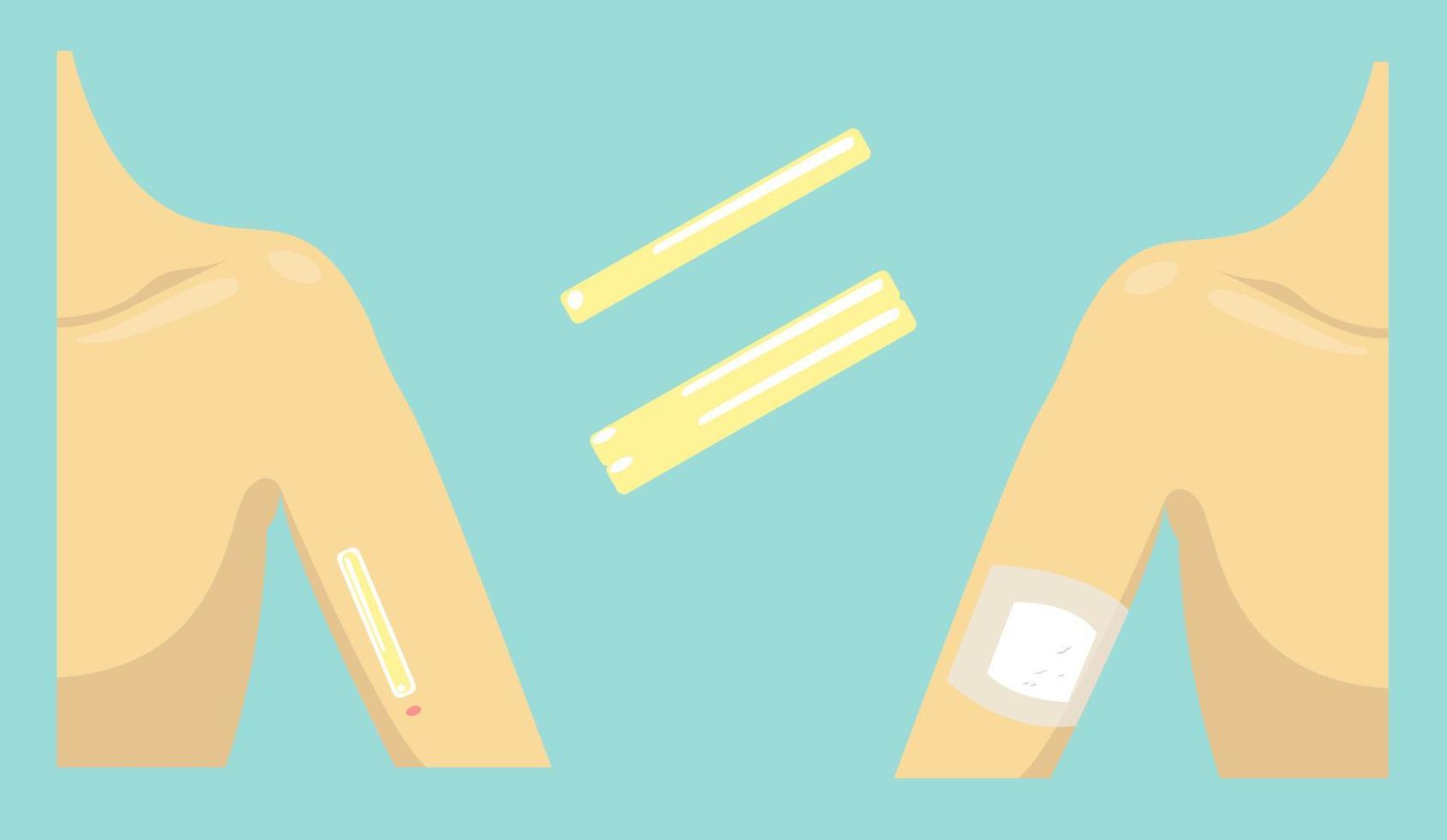 Contraceptive Implant vector illustration