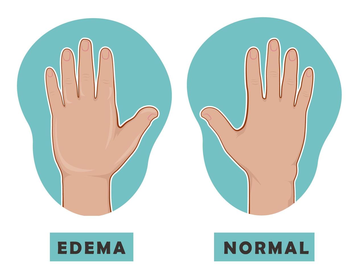 Swollen hand and normal hand. Edema and lymphedema. Vector illustration of the disease before-after.