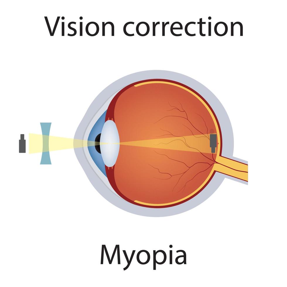 corrección de la visión de la ilustración de la miopía. trastornos de la vista defecto de los ojos corregido por el concepto de lente cóncava. globo ocular de anatomía detallada con defecto de miopía. vector aislado
