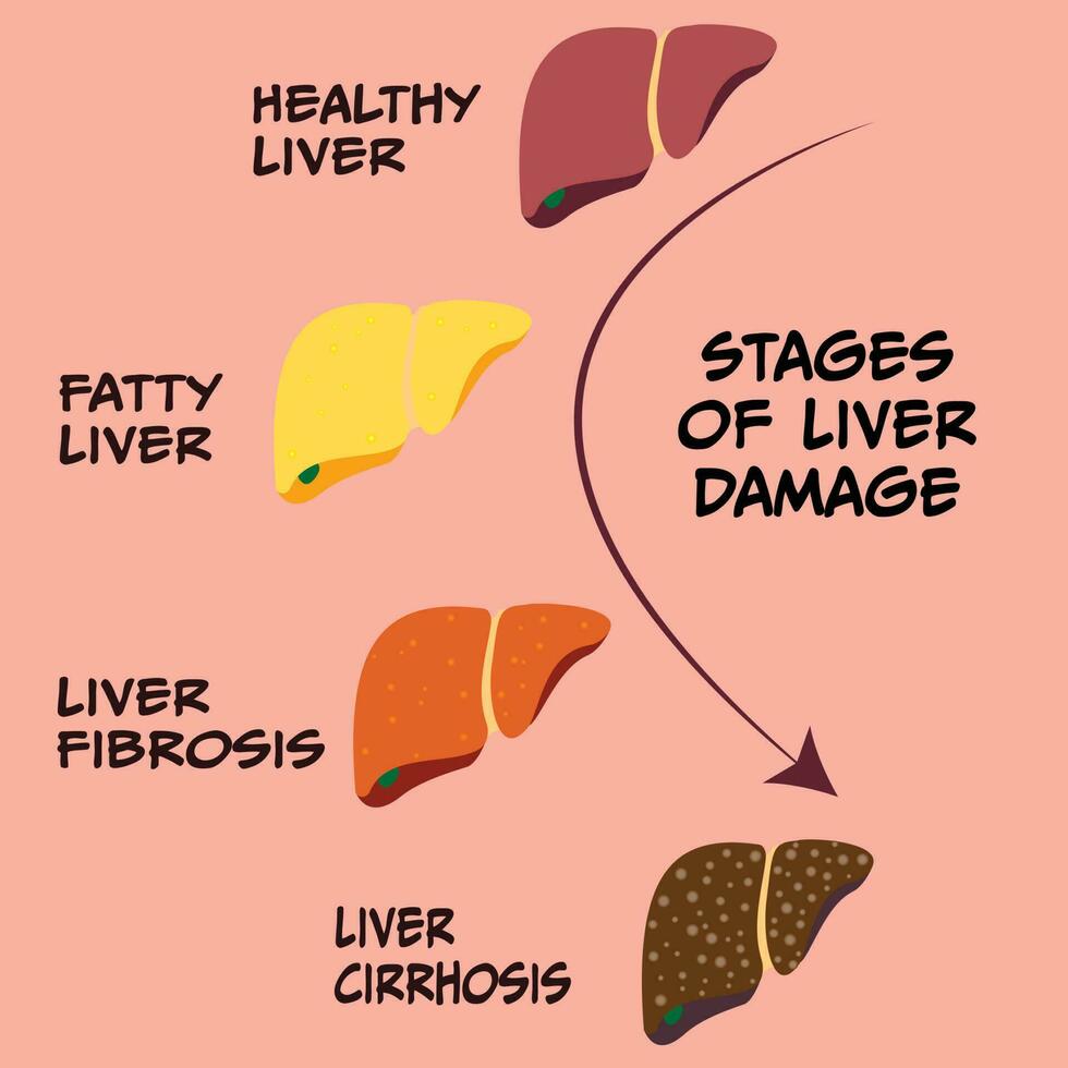Progression stages of liver disease vector