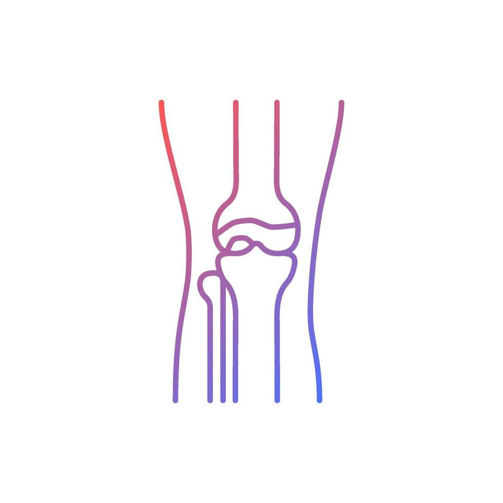 Osteoarthritis gradient linear vector icon. Cartilage inflammation. Degenerative joint disease. Pain in knee. Thin line color symbol. Modern style pictogram. Vector isolated outline drawing