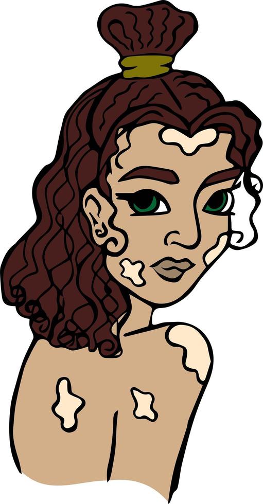 chica con vitiligo vector