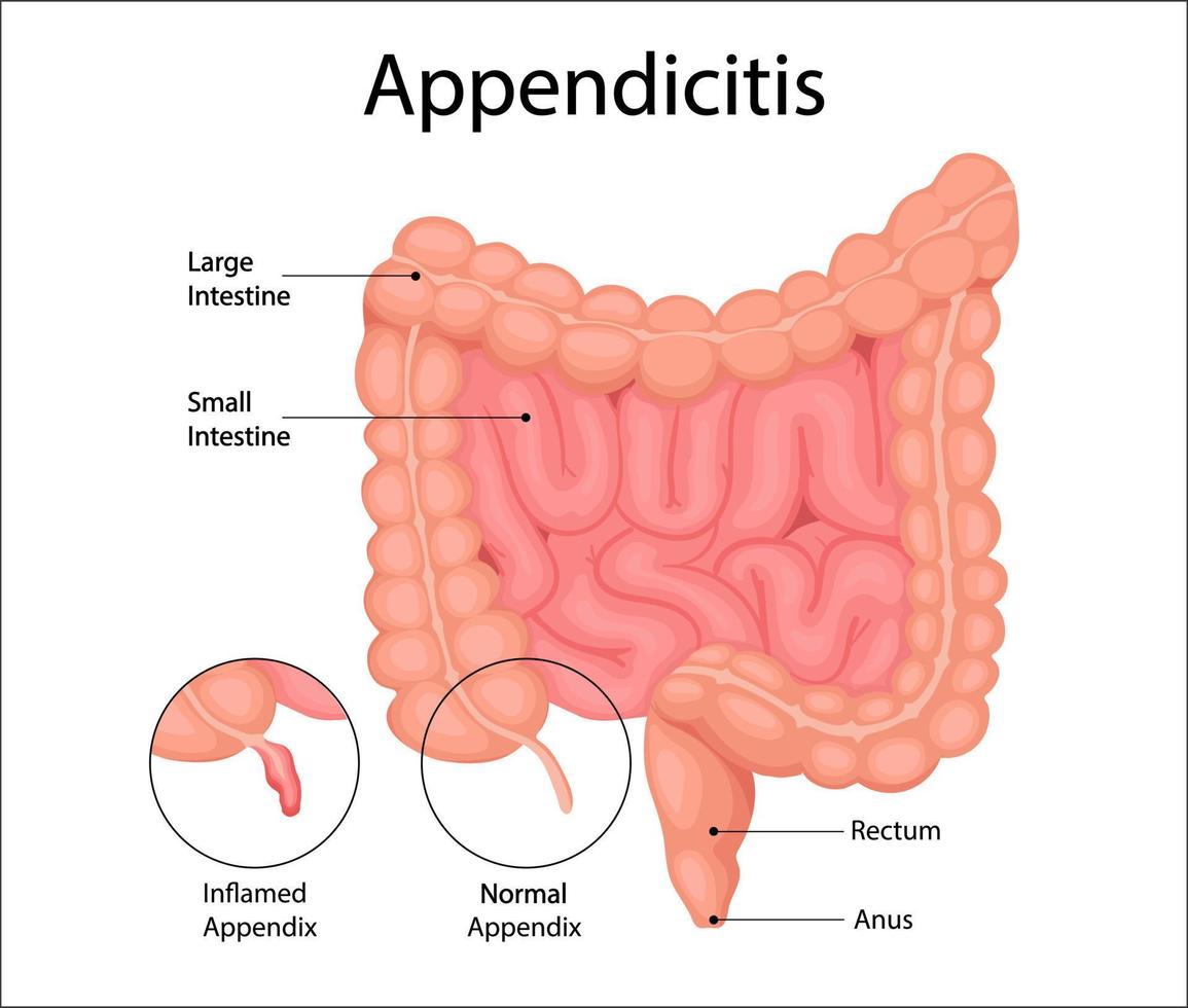 Human bladder cancer. malignant cells concept. Vector in cartoon style