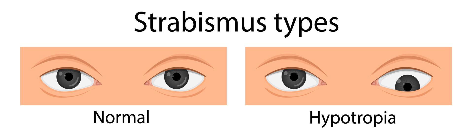 Types of strabismus. Hypotropia, hypertropia, esotropia. cartoon style vector