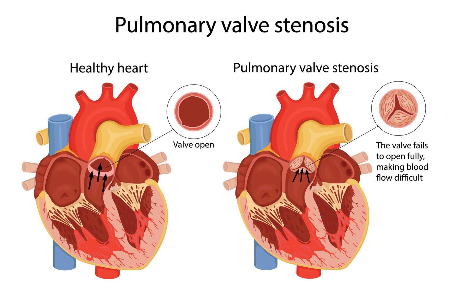 estenosis de válvula pulmonar. ilustración anatómica vector