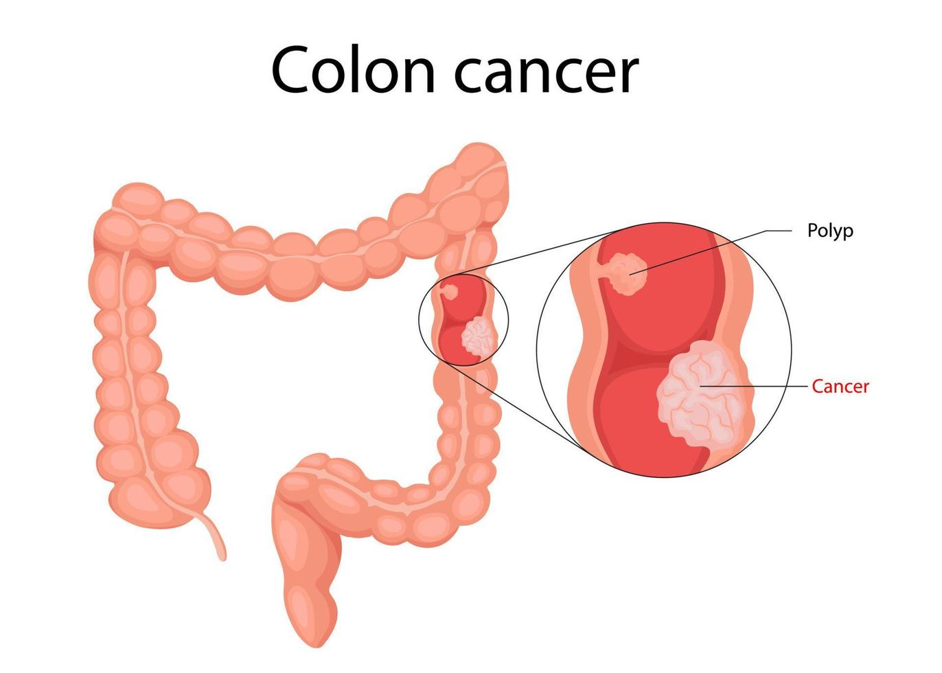 Human bladder cancer. malignant cells concept. Vector in cartoon style