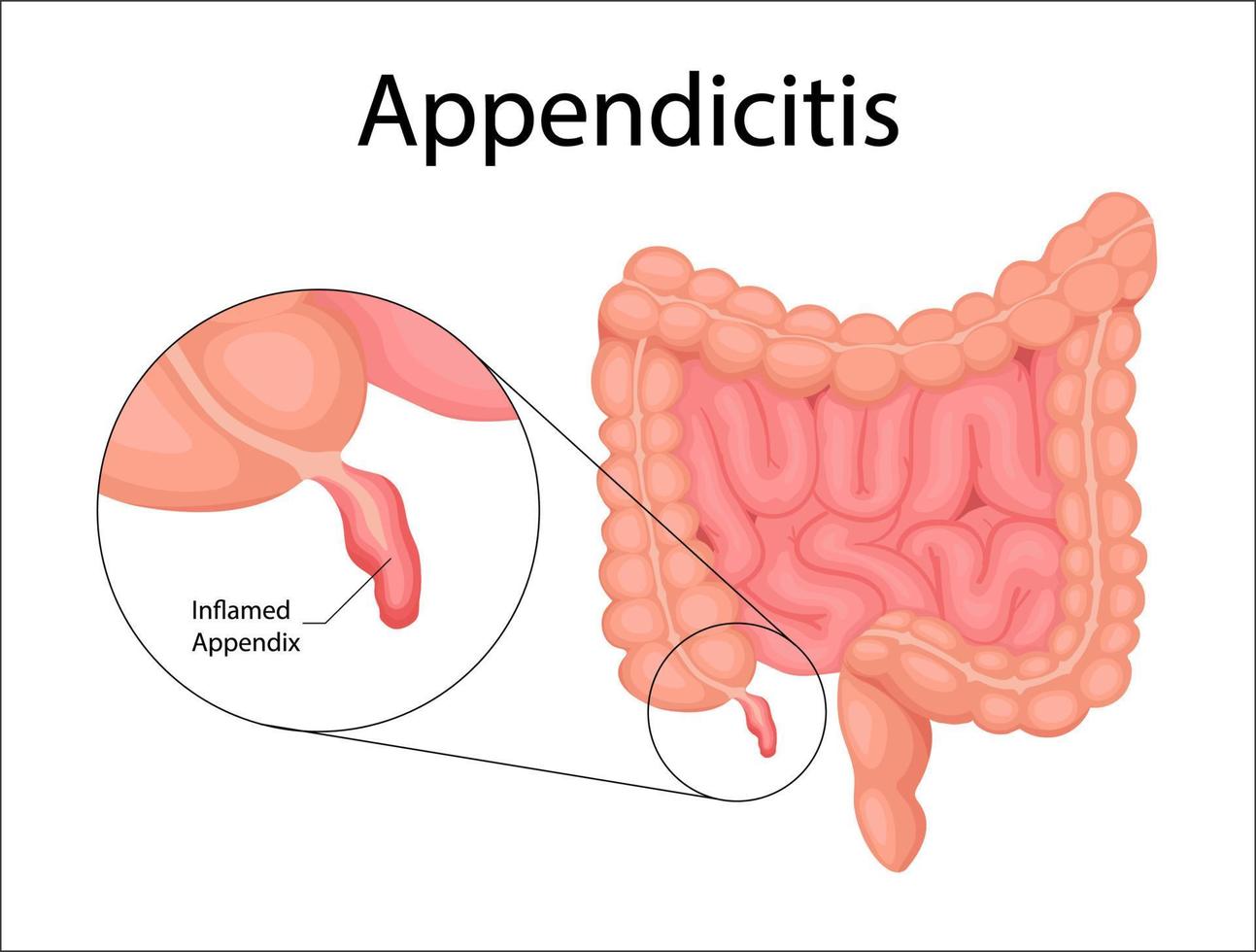 Human bladder cancer. malignant cells concept. Vector in cartoon style