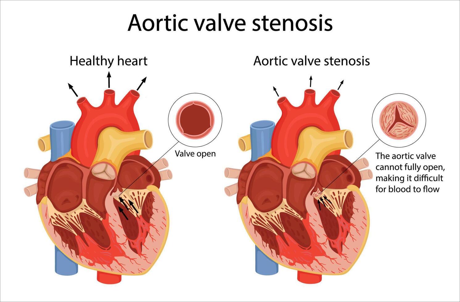 The medical illustration shows the difference between a normal aortic valve and a stenotic valve. cartoon style illustration vector