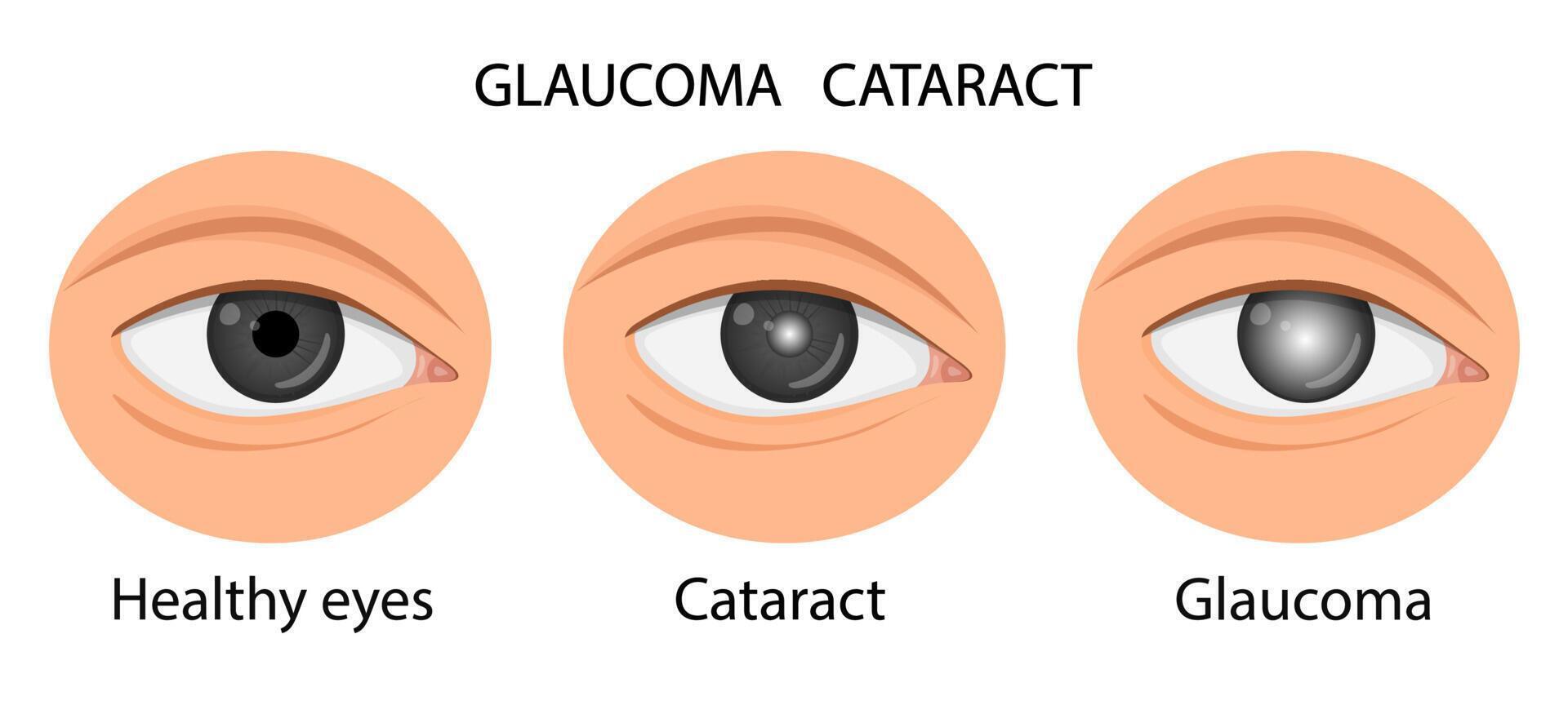 illustration of a healthy eye, glaucoma, cataract. vector