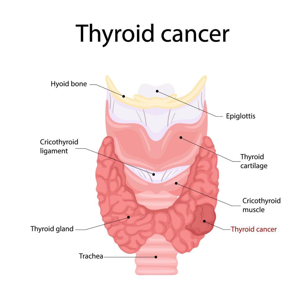 Anatomía del cáncer de tiroides. icono de la anatomía de los órganos del cuerpo humano. concepto médico. vector