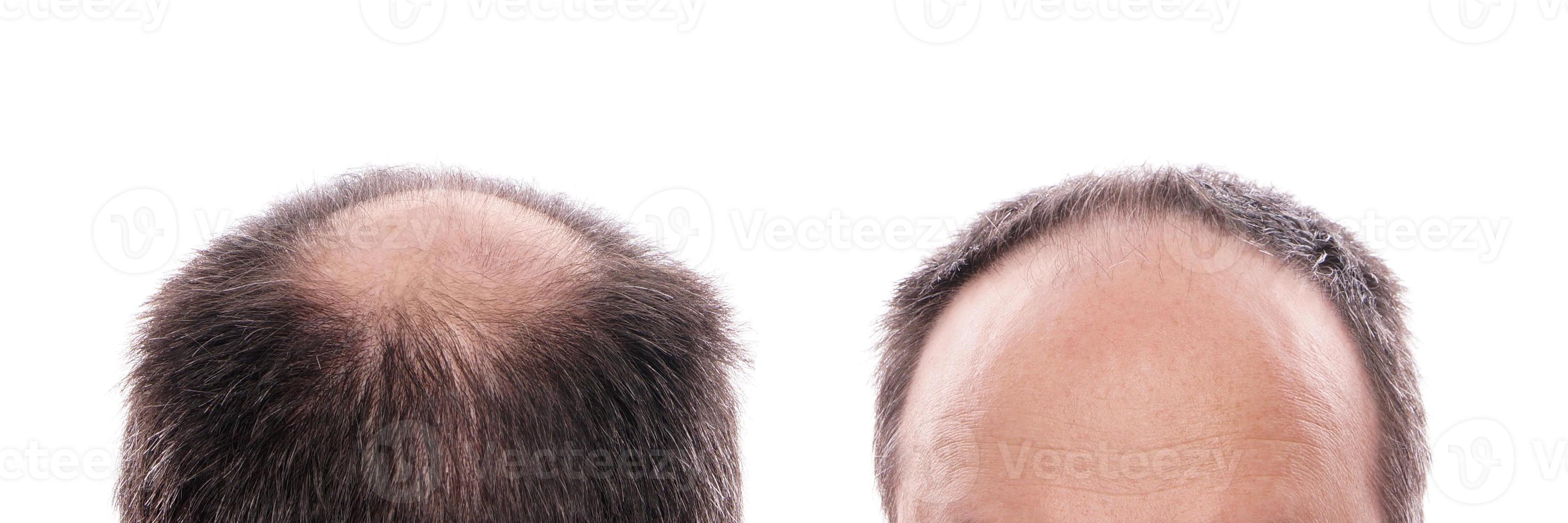 hair loss or going bald photo