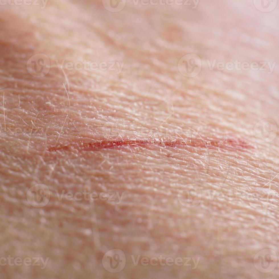 skin cut macro photo