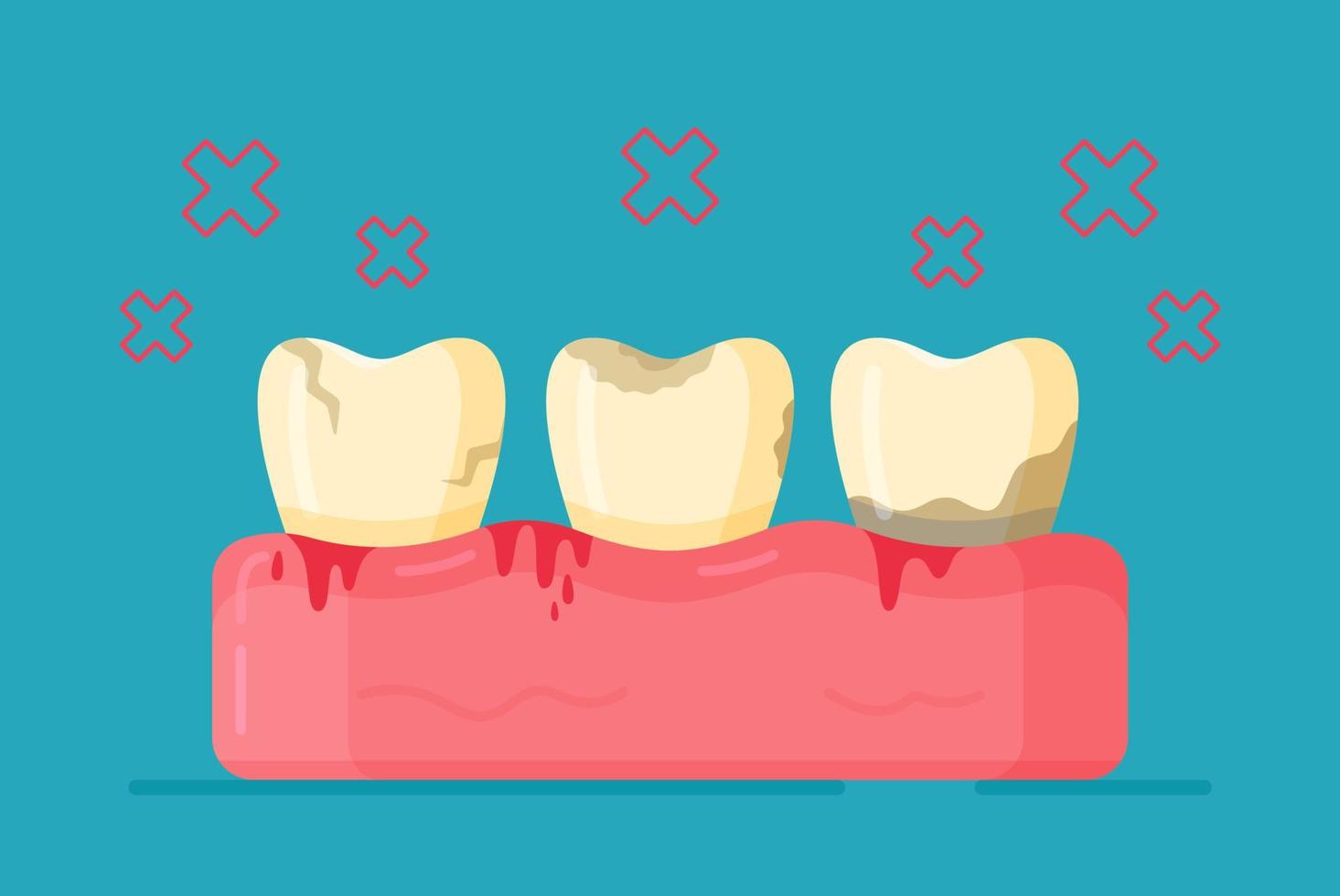 ilustración vectorial de enfermedades dentales. no higiénico. yendo al dentista. vector