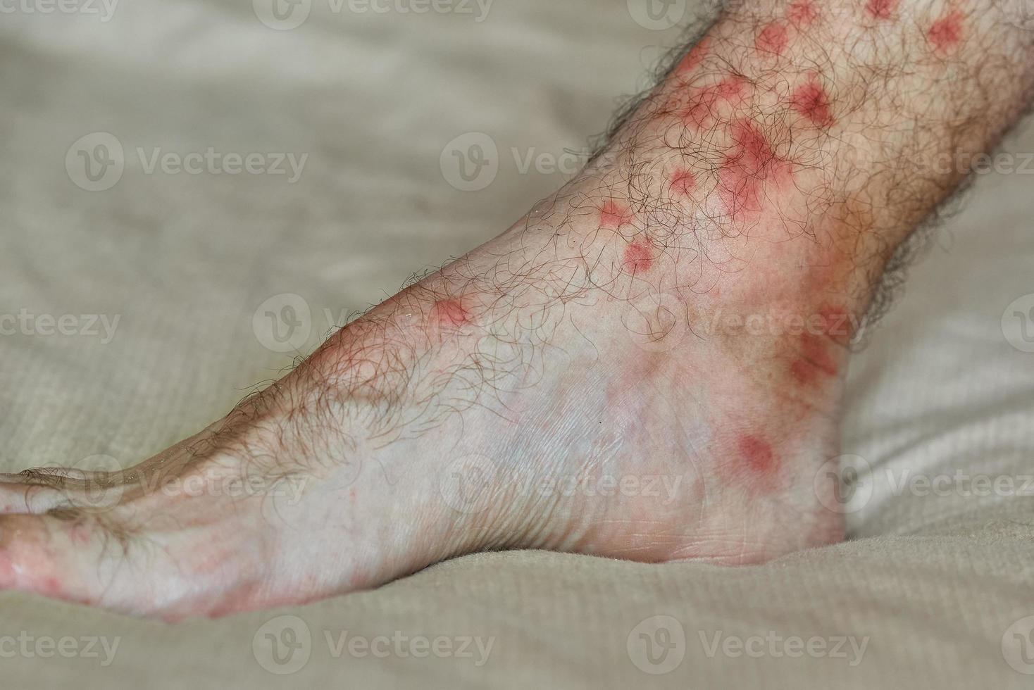 manchas rojas en la piel. pierna masculina con muchas manchas rojas y cicatriz por picadura de insecto. foto