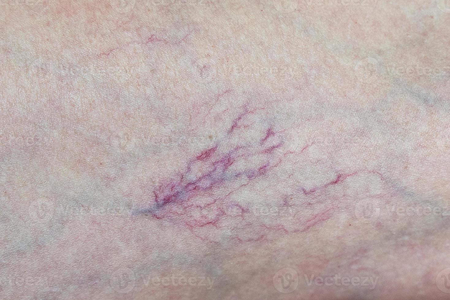 Varicose veins on the leg close-up. The concept of the need for the help of a phlebologist. photo