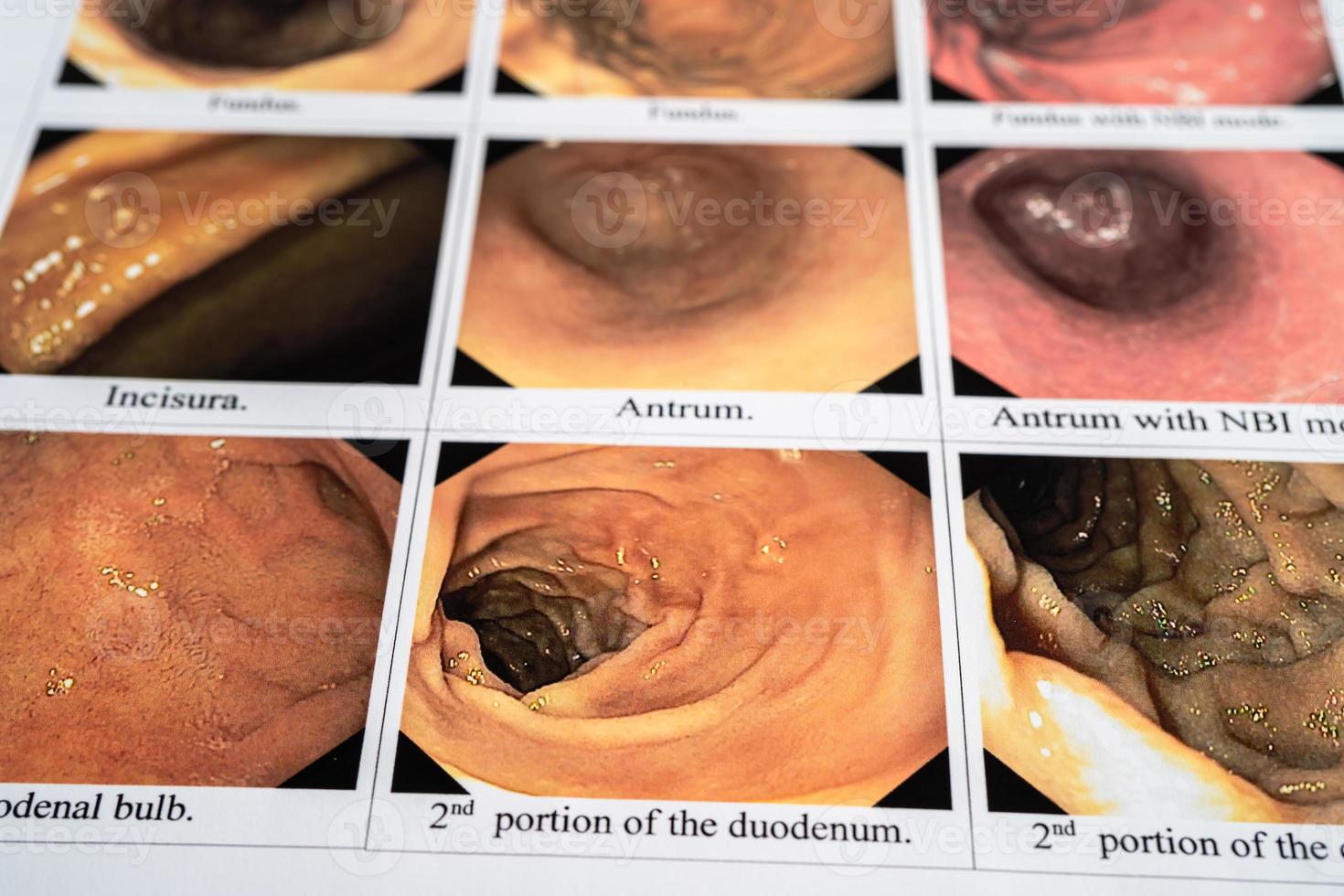Esophagogastroduodenoscopy, EGD examination report of a Asian woman patient with Gastroscopy in hospital. photo