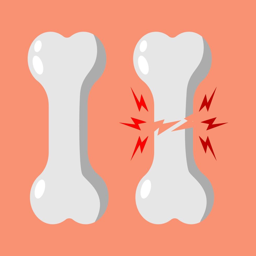 illustration of healthy bones and fractured bones. vector