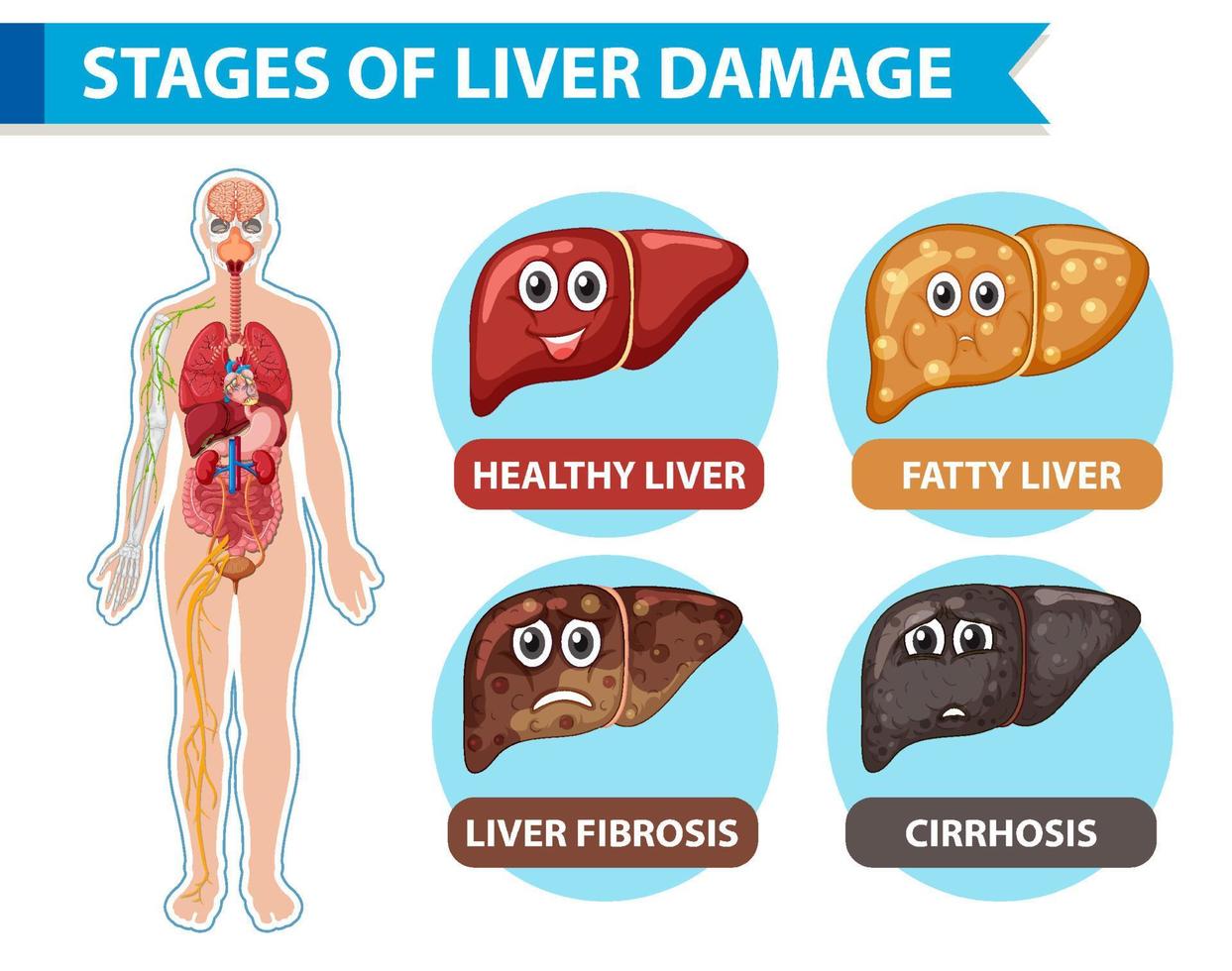 Diagram showing stages of liver damage vector