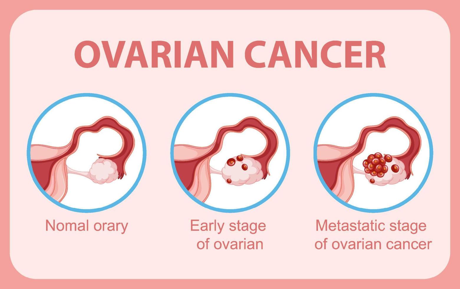 Ovarian cancer infographic infographic vector