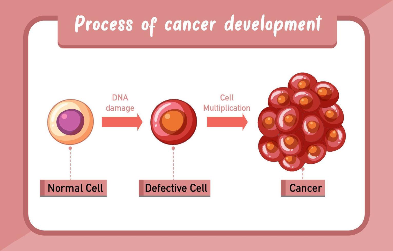 Infografía del proceso de desarrollo del cáncer. vector