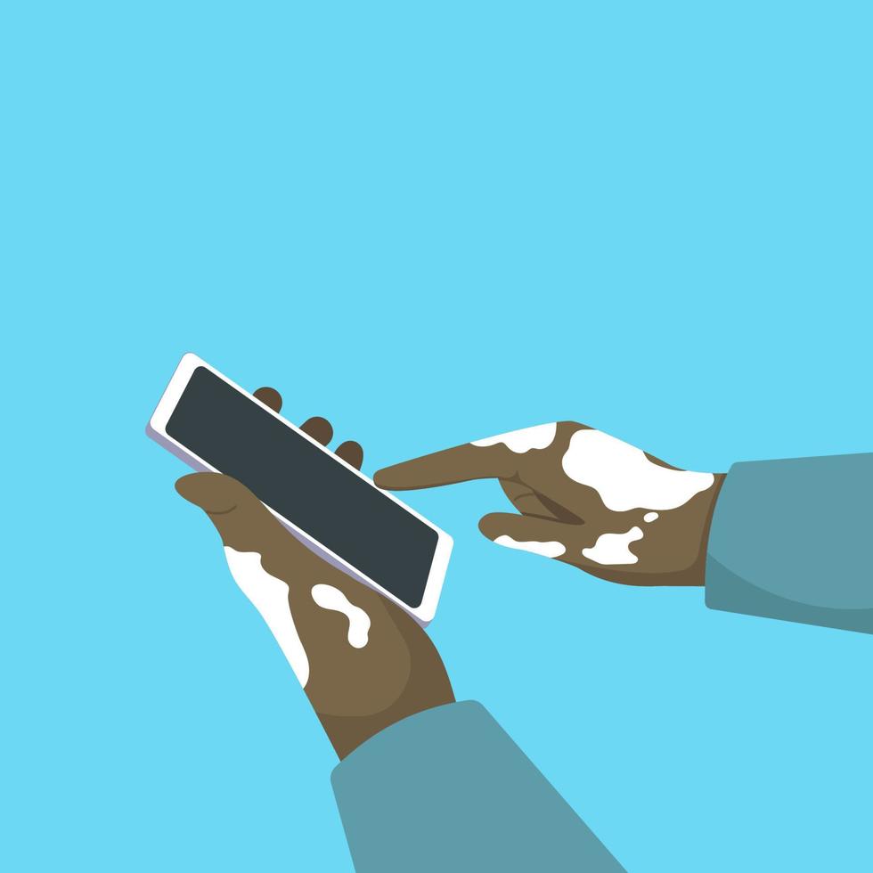 Human hands close-up affected by the Skin Disease Vitiligo use a smartphone. A dark-skinned man with vitiligo. Communication technologies. Vector illustration isolated on a white background.