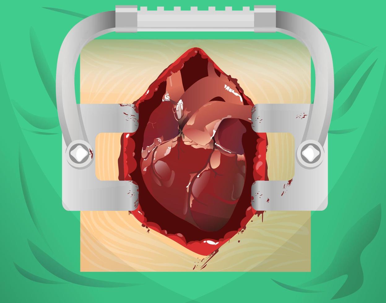 open heart surgery medical vector