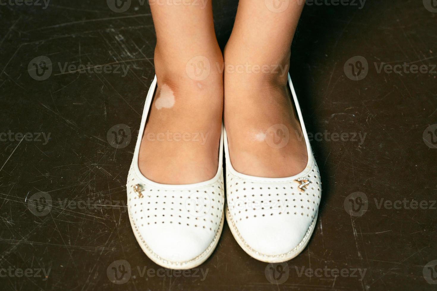 vitiligo child legs photo